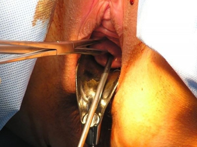 Hysteroskopie
