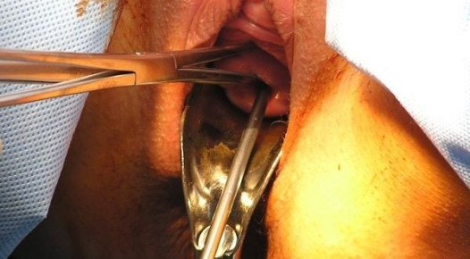 Hysteroskopie