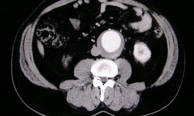 CT aneurysma