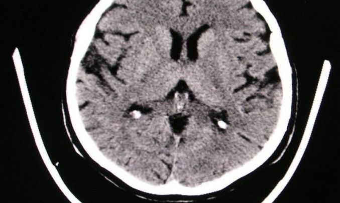 CT mozek