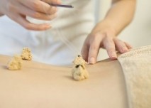 Moxibustion