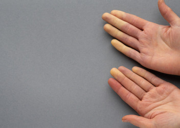Ruce s nedokrvenými prsty