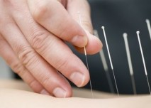Akupunktura
