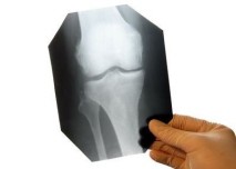 RTG,rentgen,koleno,lékař,doktor