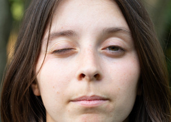 Myasthenia Gravis portrét