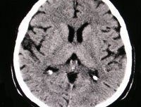 CT mozek
