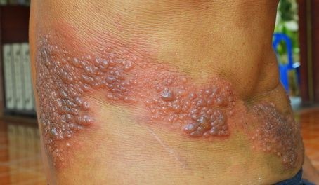 Herpes kouření