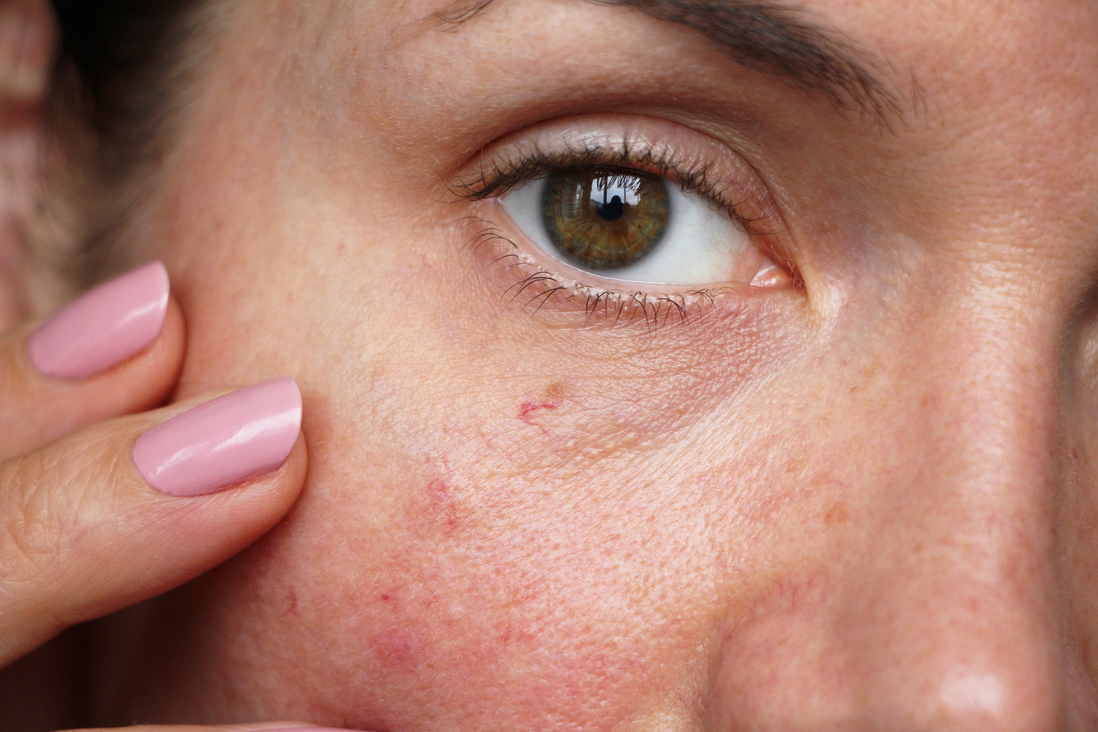 Jak odstranit červené žilky v obličeji?